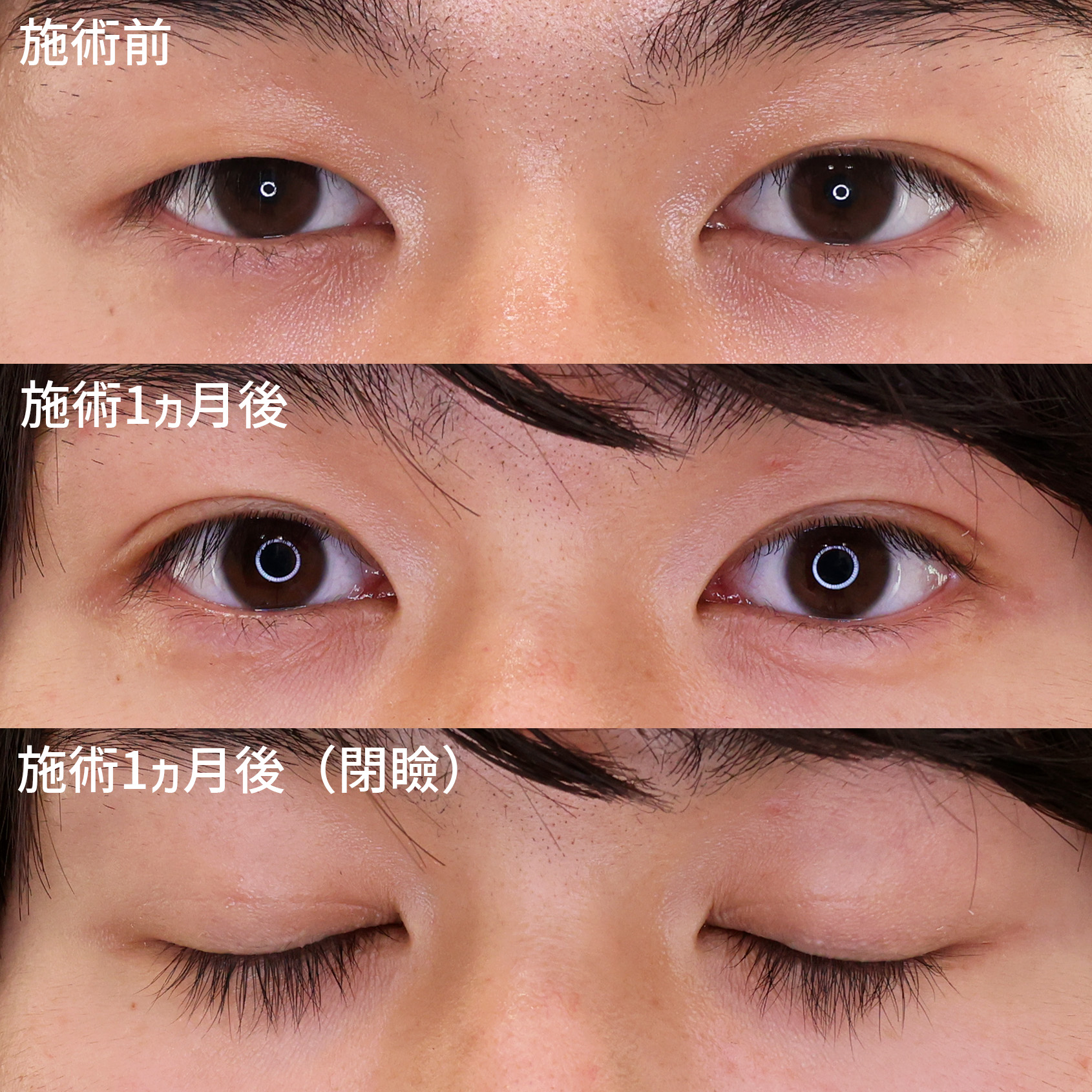 クイックコスメリングの症例写真 施術前後 