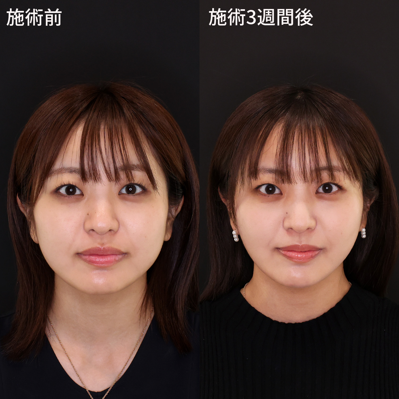 美しい輪郭はつくれる！【糸リフト＋エラボト】で卵型のフェイスラインに！