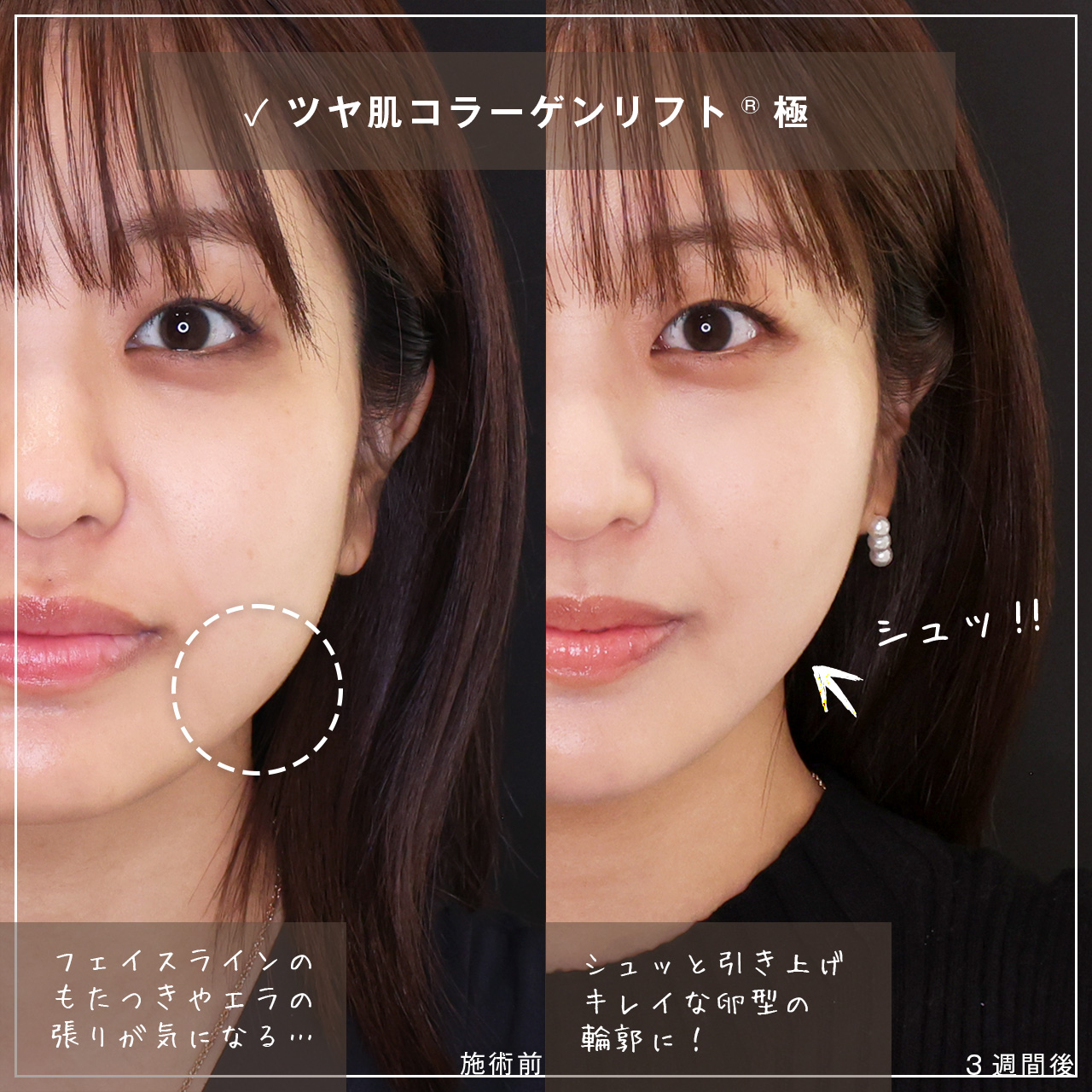 TAC式 ツヤ肌コラーゲンリフト®/エラボトックス注射の症例写真 施術前後 