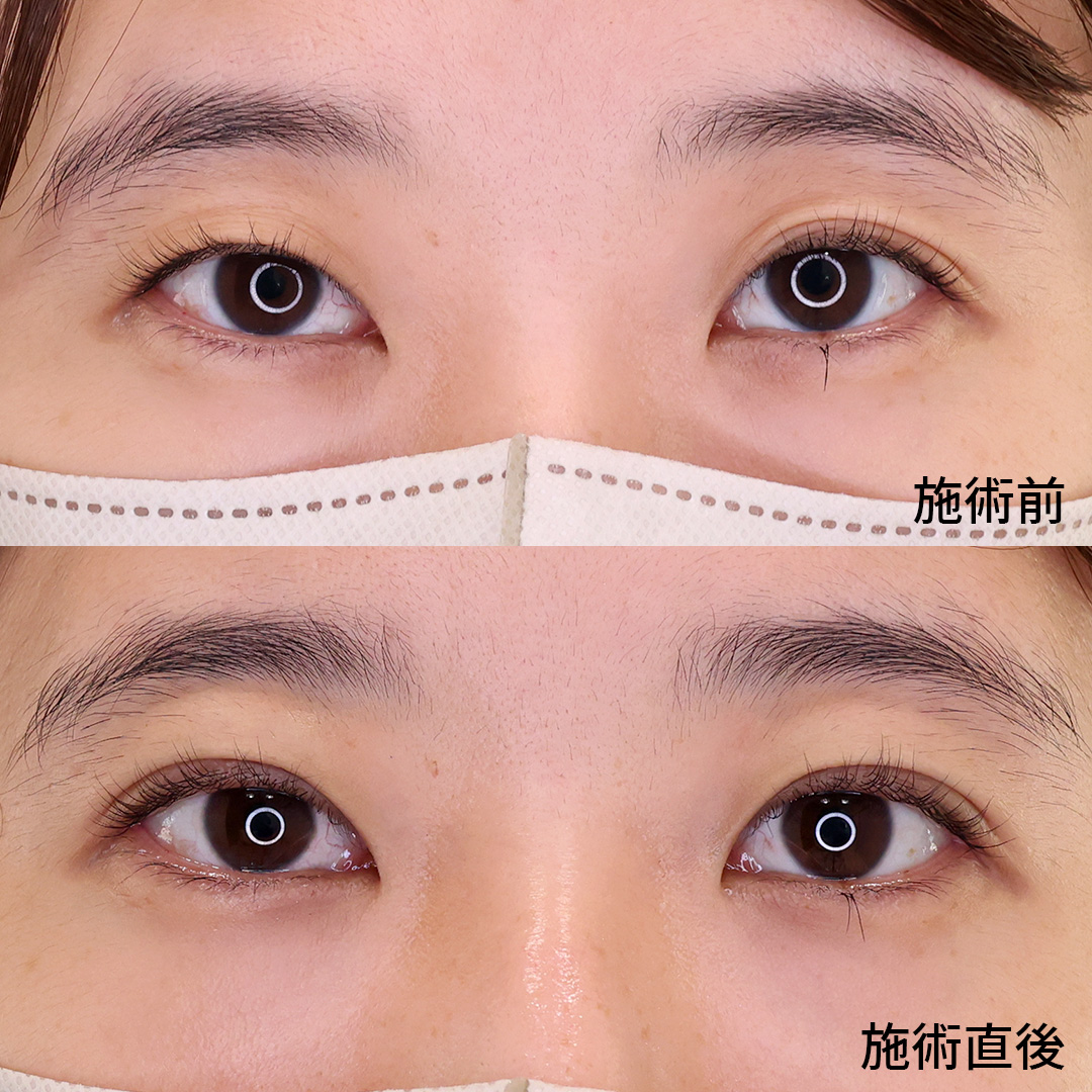 二重埋没法の症例写真 施術前後