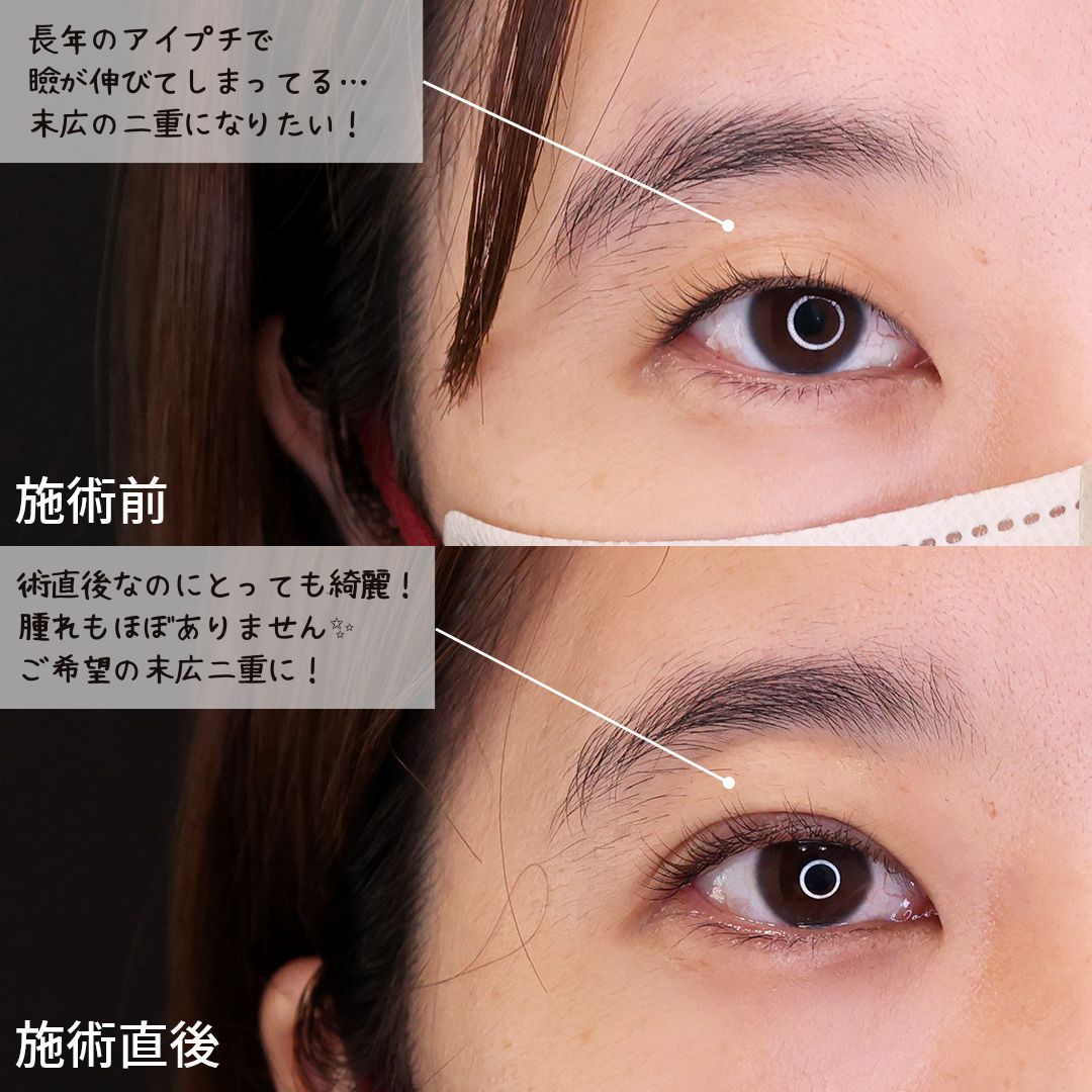 二重埋没法の症例写真 施術前後