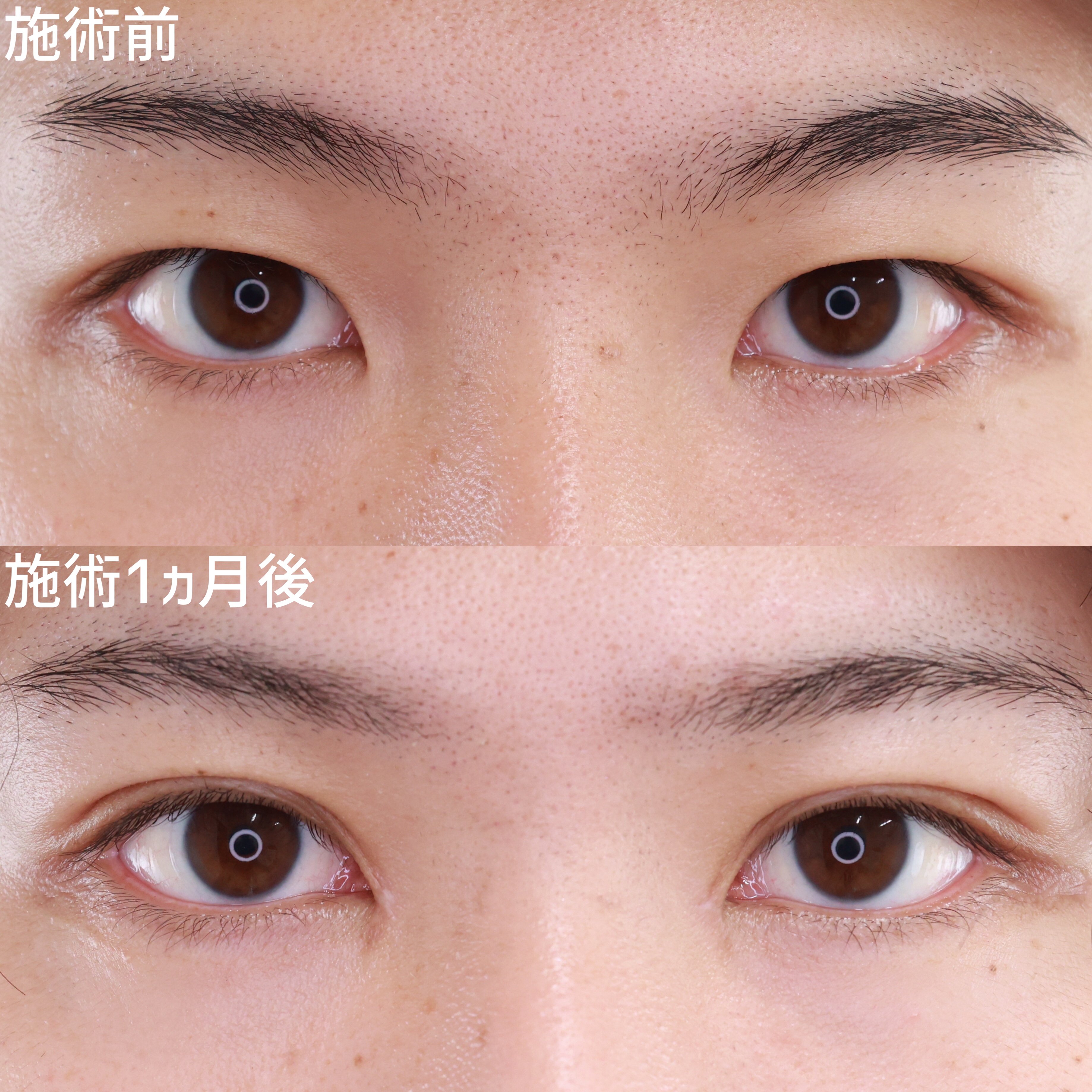 二重埋没法/目頭切開術/目元:その他の症例写真 施術前後