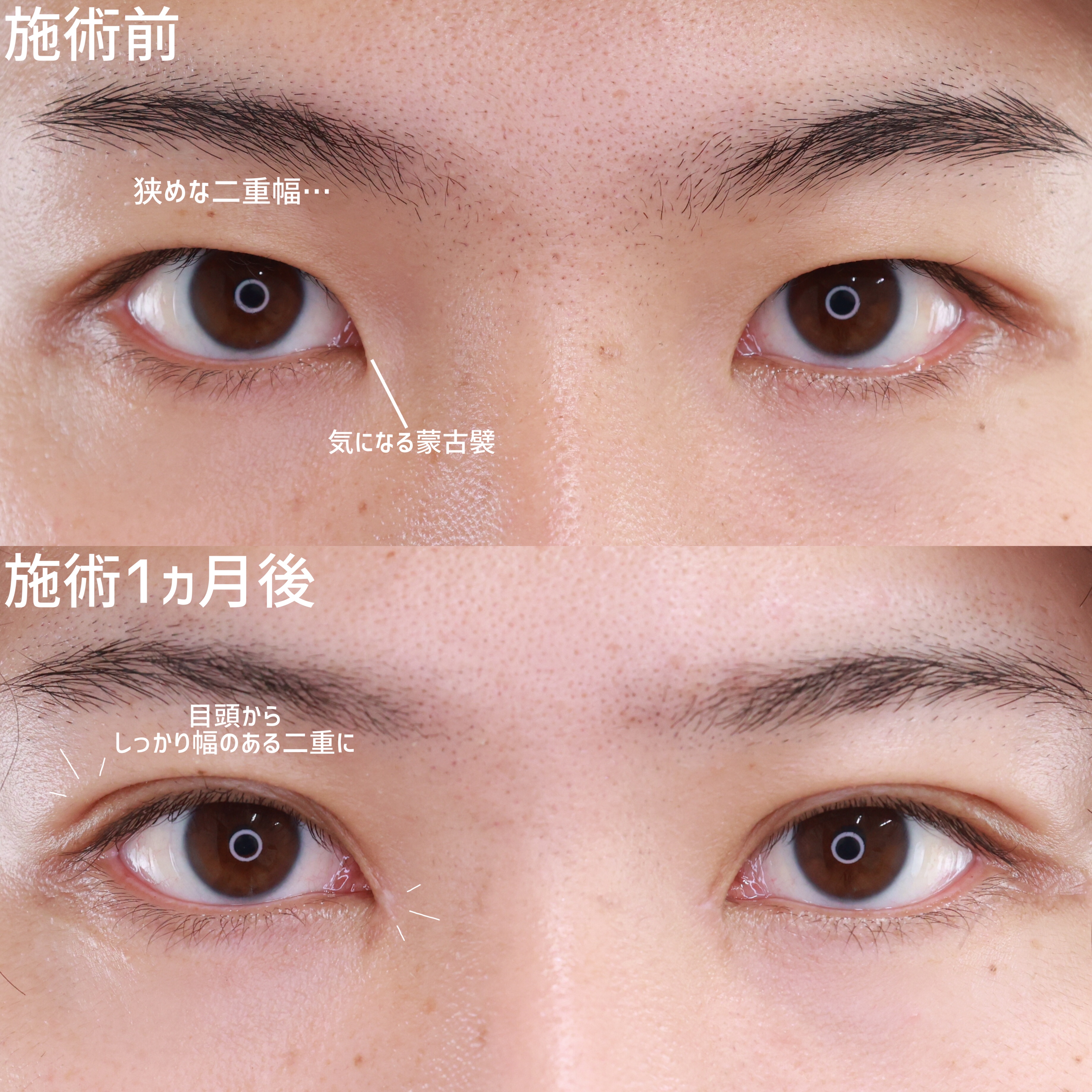 二重埋没法/目頭切開術/目元:その他の症例写真 施術前後