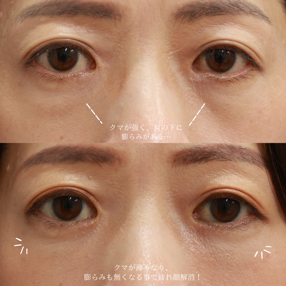 下眼瞼脱脂術（目の下のたるみ取り・目の下の脂肪ふくらみ取り）/顔の脂肪注入(コンデンスリッチフェイス)の症例写真 施術前後 
