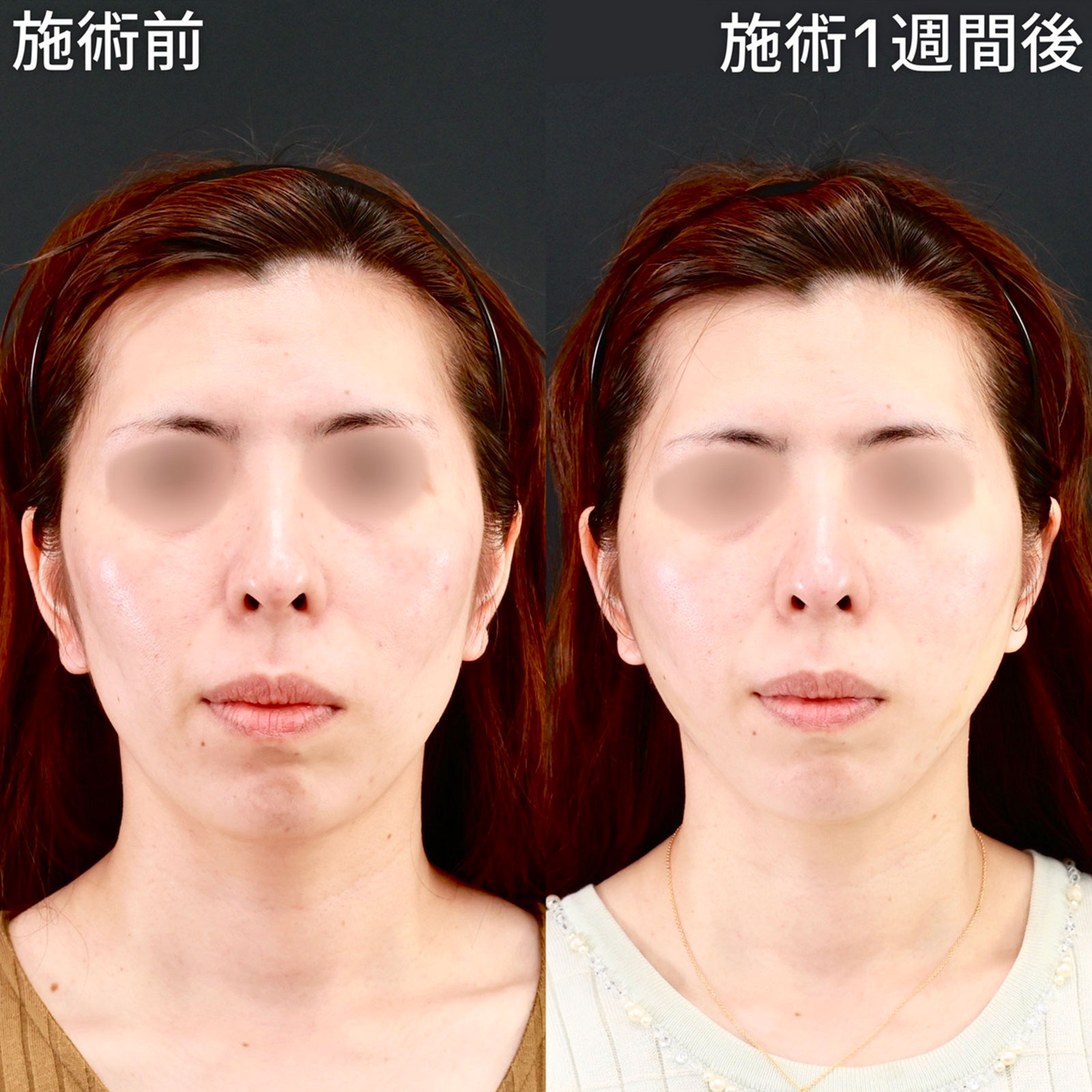 【糸リフト極】リフトアップで面長を改善！