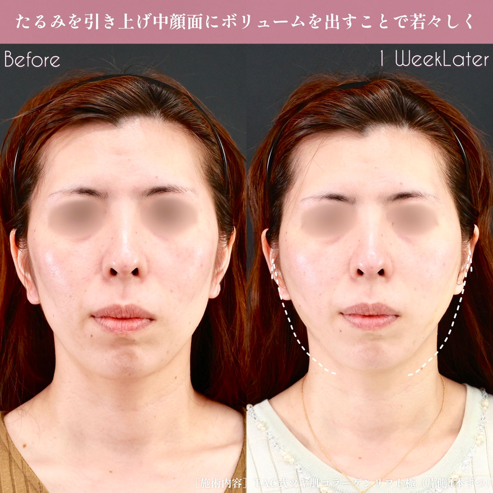 TAC式 ツヤ肌コラーゲンリフト®の症例写真 施術前後 