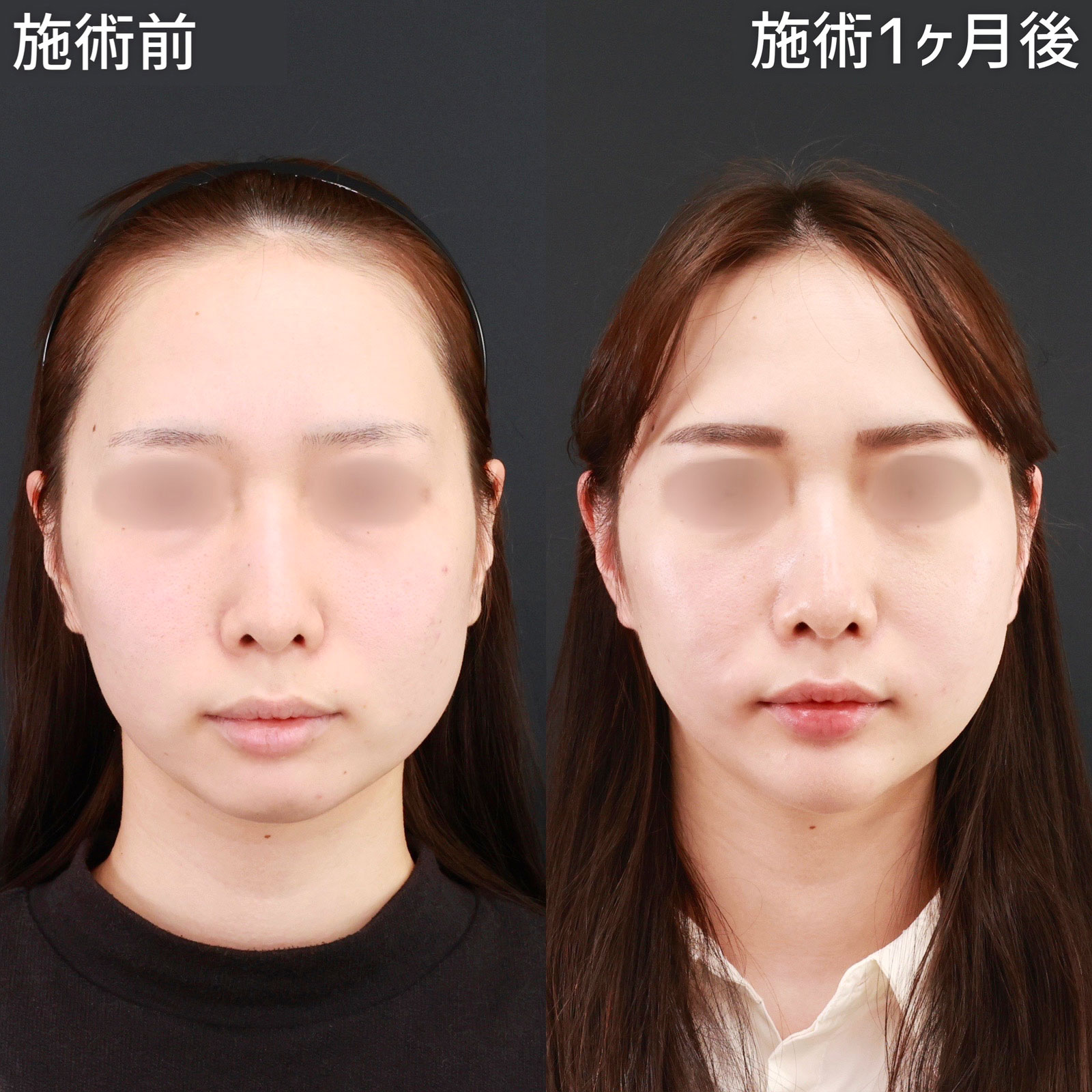 【パーフェクトフェイスライン】輪郭の左右差を改善しつつ、卵型の輪郭を形成!
