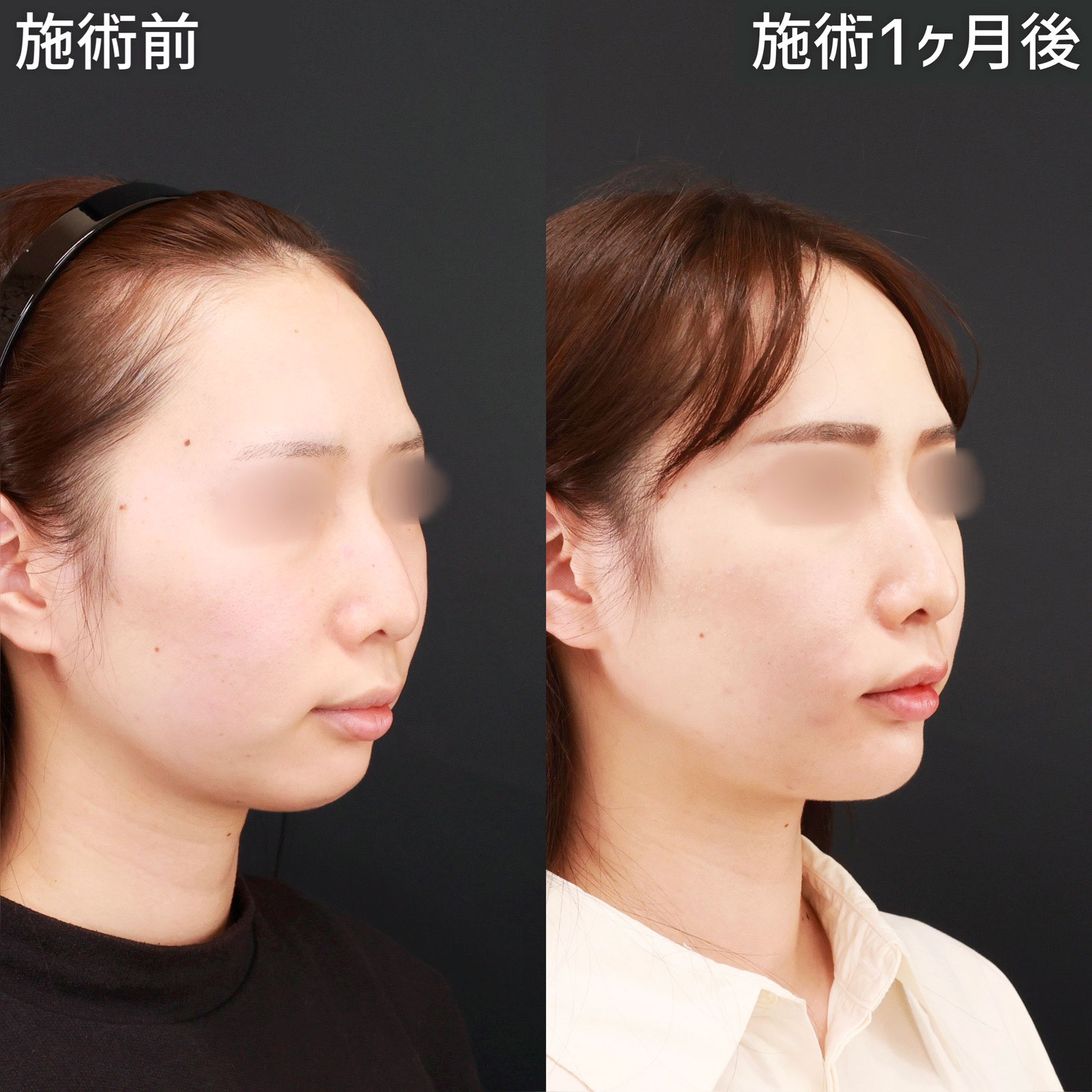 エラボトックス注射/ジョールファット除去/小顔整形｜パーフェクトフェイスラインの症例写真 施術前後 