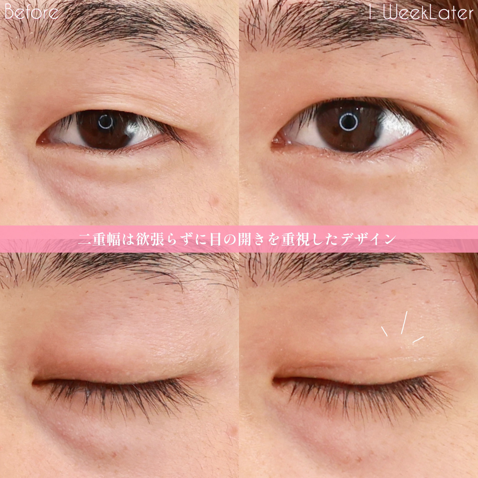 二重埋没法の症例写真 施術前後 