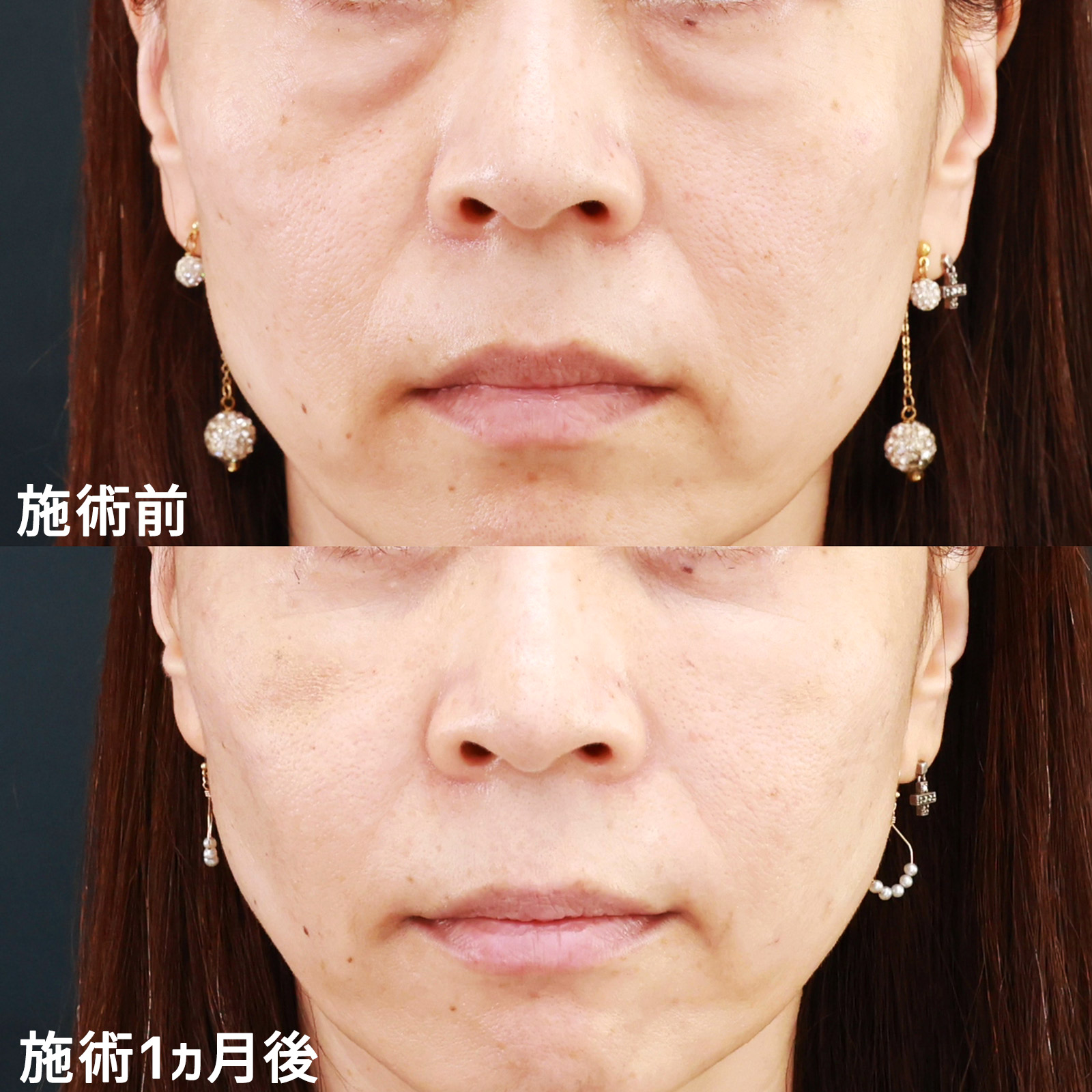 【下眼瞼脱脂術＆脂肪注入】老け見えする目の下のクマを改善して、若々しく！