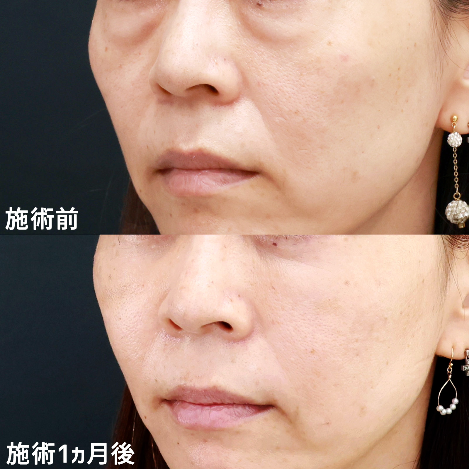 下眼瞼脱脂術（目の下のたるみ取り・目の下の脂肪ふくらみ取り）/顔の脂肪注入(コンデンスリッチフェイス)の症例写真 施術前後 