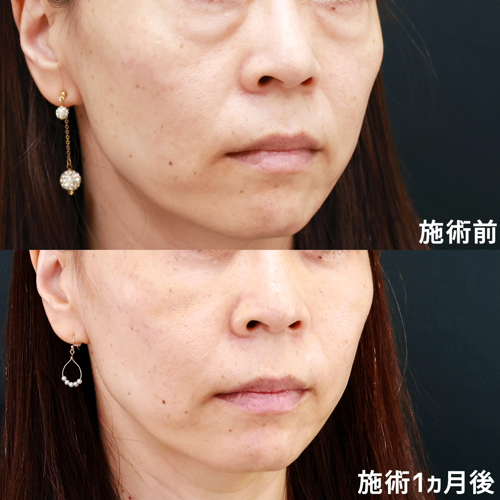 下眼瞼脱脂術（目の下のたるみ取り・目の下の脂肪ふくらみ取り）/顔の脂肪注入(コンデンスリッチフェイス)の症例写真 施術前後 