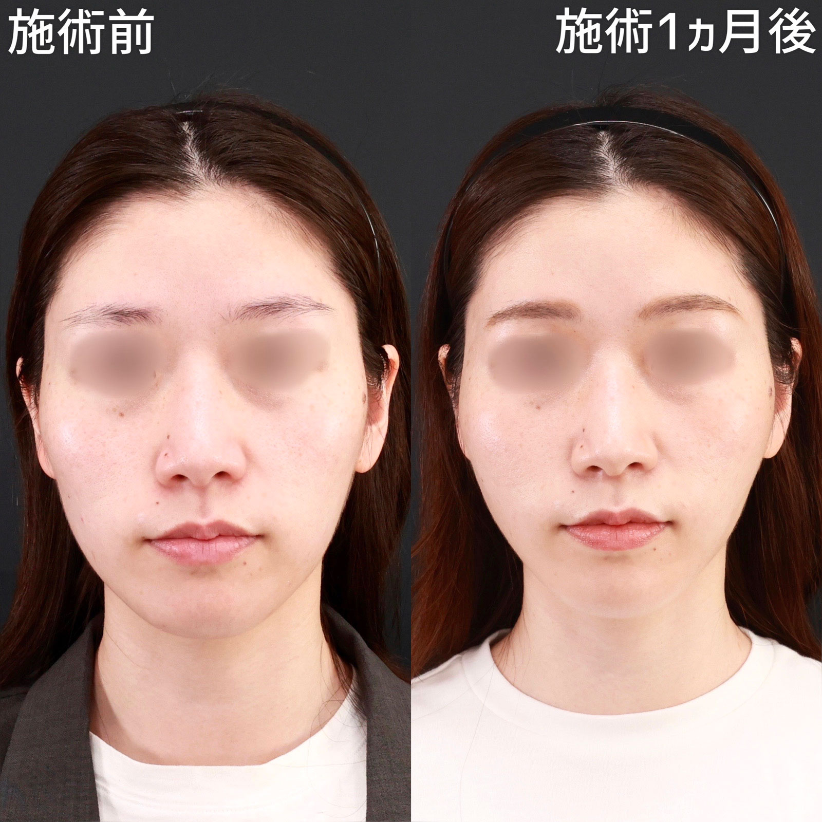 【糸リフト＆ジョールファット除去】脂肪とたるみにアプローチして、美しいVラインを形成！