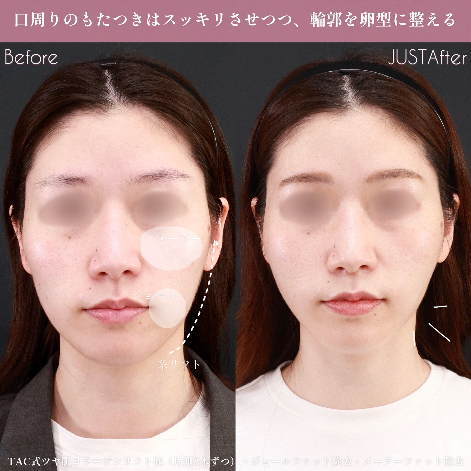 ジョールファット除去/メーラーファット除去/TAC式 ツヤ肌コラーゲンリフト®の症例写真 施術前後 