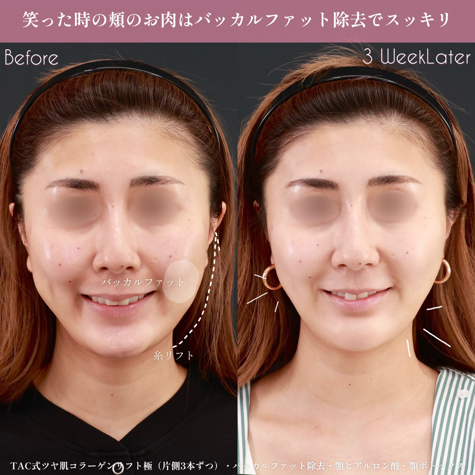 顎のヒアルロン酸注射/バッカルファット除去/TAC式 ツヤ肌コラーゲンリフト®の症例写真 施術前後 