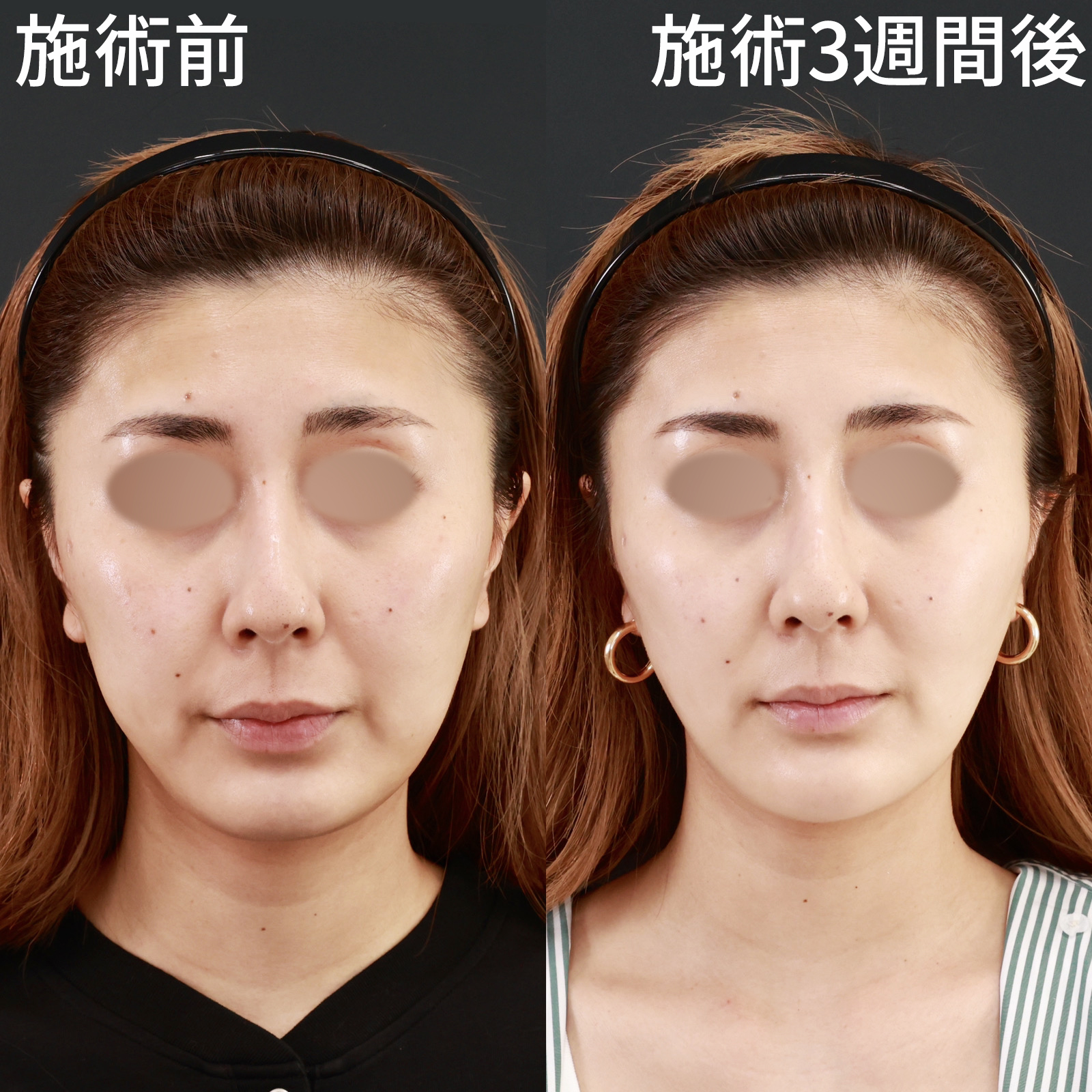 顎のヒアルロン酸注射/バッカルファット除去/TAC式 ツヤ肌コラーゲンリフト®の症例写真 施術前後 