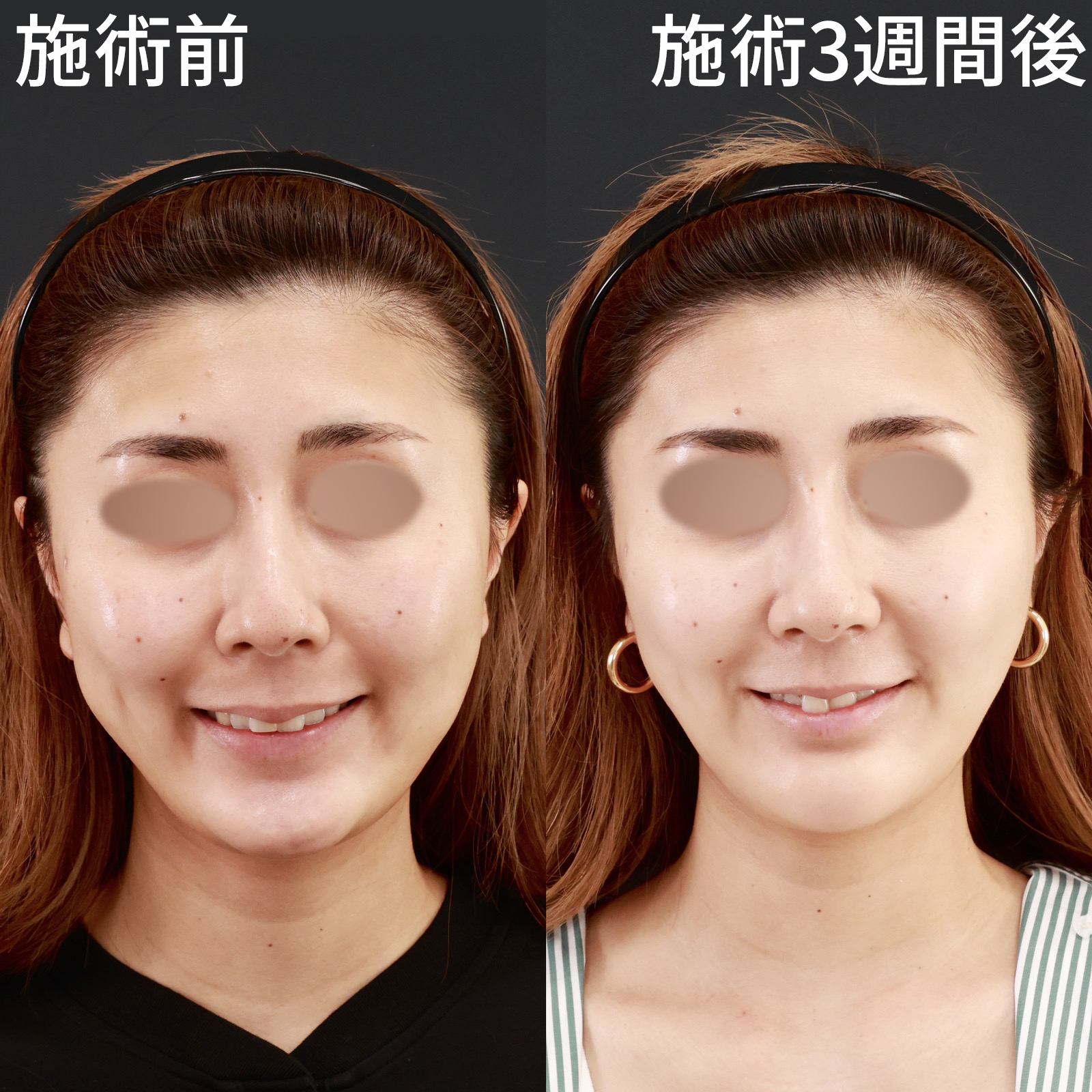 【バッカルファット除去】笑顔の時もスッキリと！より美しい輪郭に