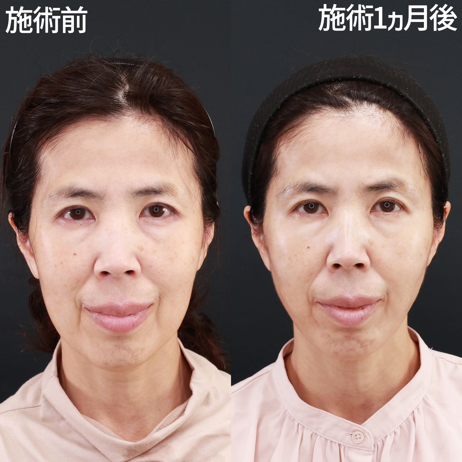 【ジョールファット除去】口横のシワを改善し、脱ブルドック顔！！