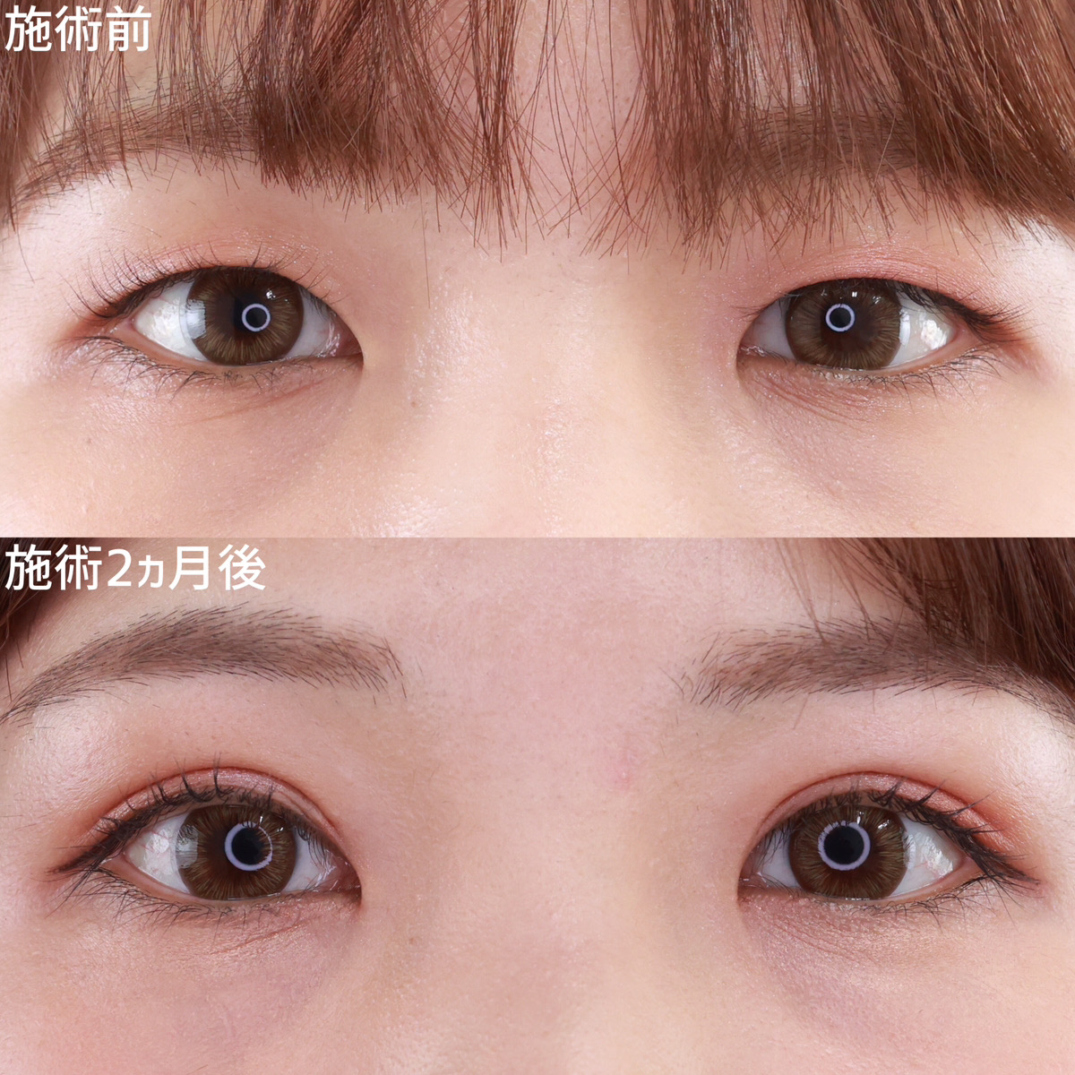 【二重埋没法】自然なMIX二重で可愛さUP