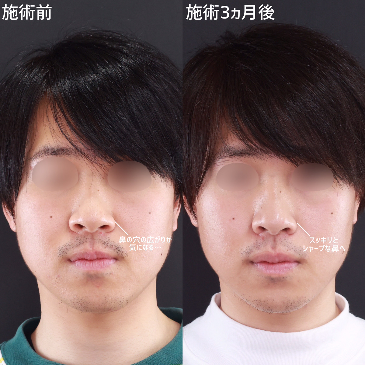 TAC式 鼻翼縮小術(小鼻縮小)の症例写真 施術前後