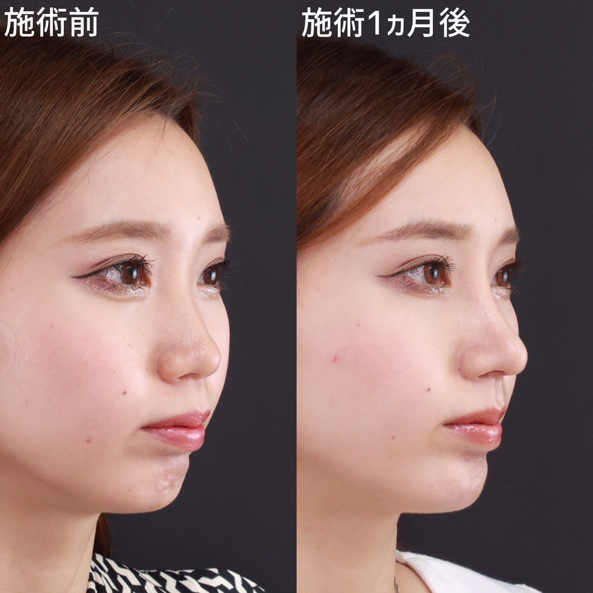 鼻尖形成・鼻尖縮小/鼻中隔延長術/鼻先軟骨移植の症例写真 施術前後 