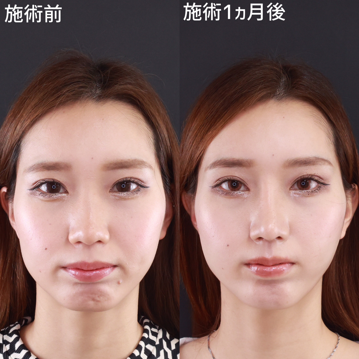 鼻尖形成・鼻尖縮小/鼻中隔延長術/鼻先軟骨移植の症例写真 施術前後 