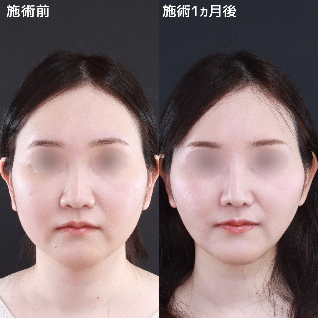 鼻先軟骨移植/鼻尖形成・鼻尖縮小/隆鼻術（プロテーゼ・自家組織）の症例写真 施術前後 