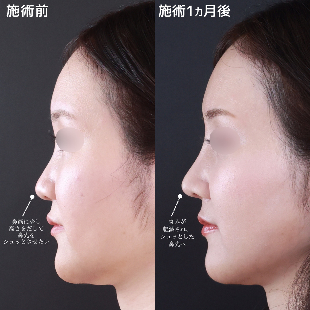 鼻先軟骨移植/鼻尖形成・鼻尖縮小/隆鼻術（プロテーゼ・自家組織）の症例写真 施術前後 
