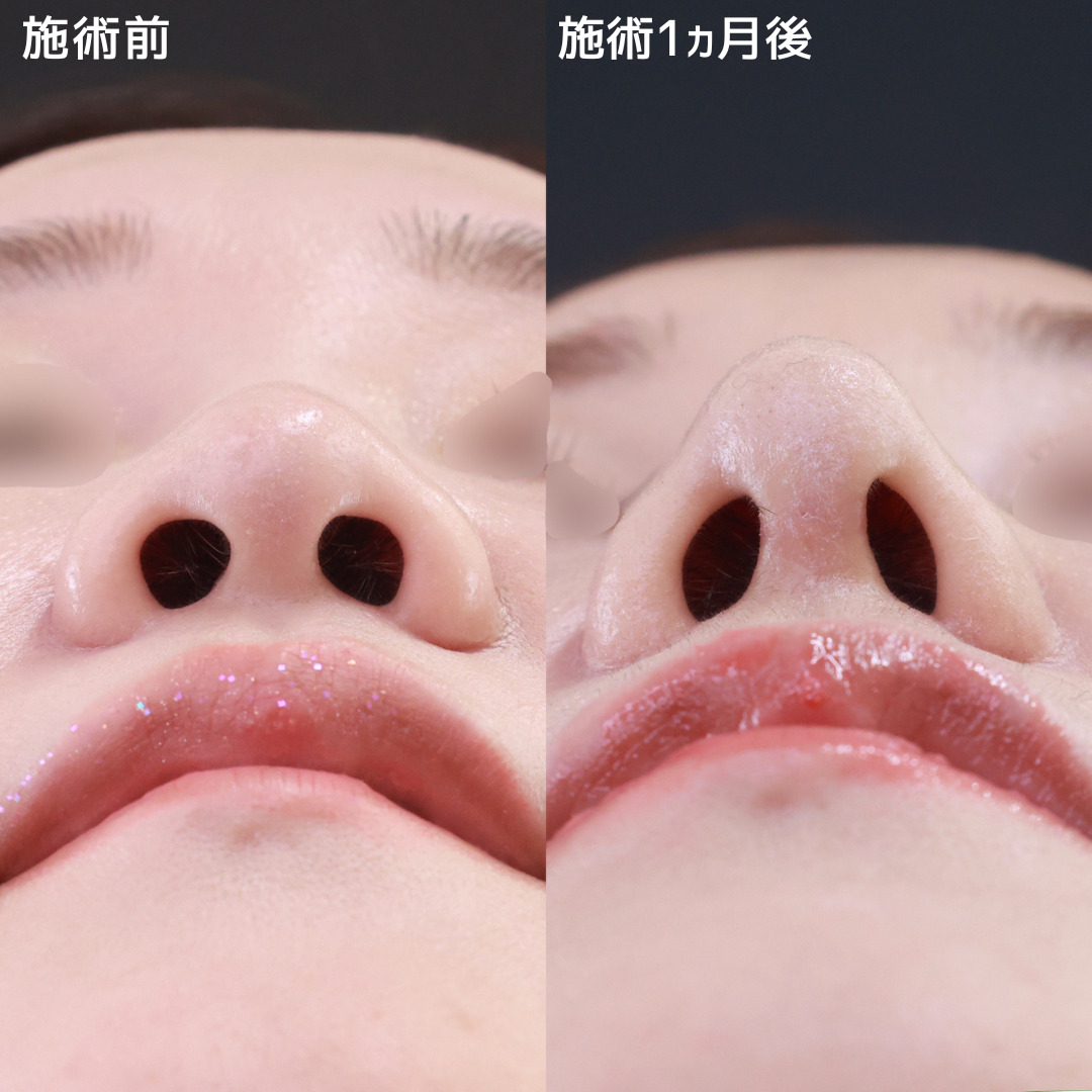 鼻先軟骨移植/鼻尖形成・鼻尖縮小/隆鼻術（プロテーゼ・自家組織）の症例写真 施術前後 