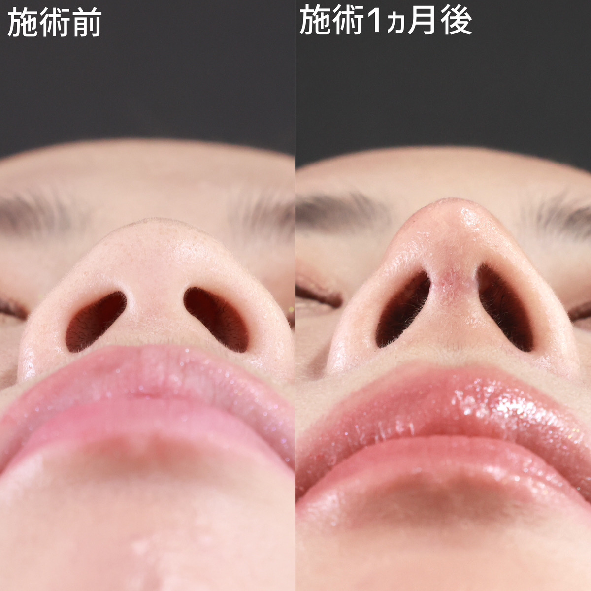 鼻尖形成・鼻尖縮小/鼻中隔延長術/隆鼻術（プロテーゼ・自家組織）の症例写真 施術前後 