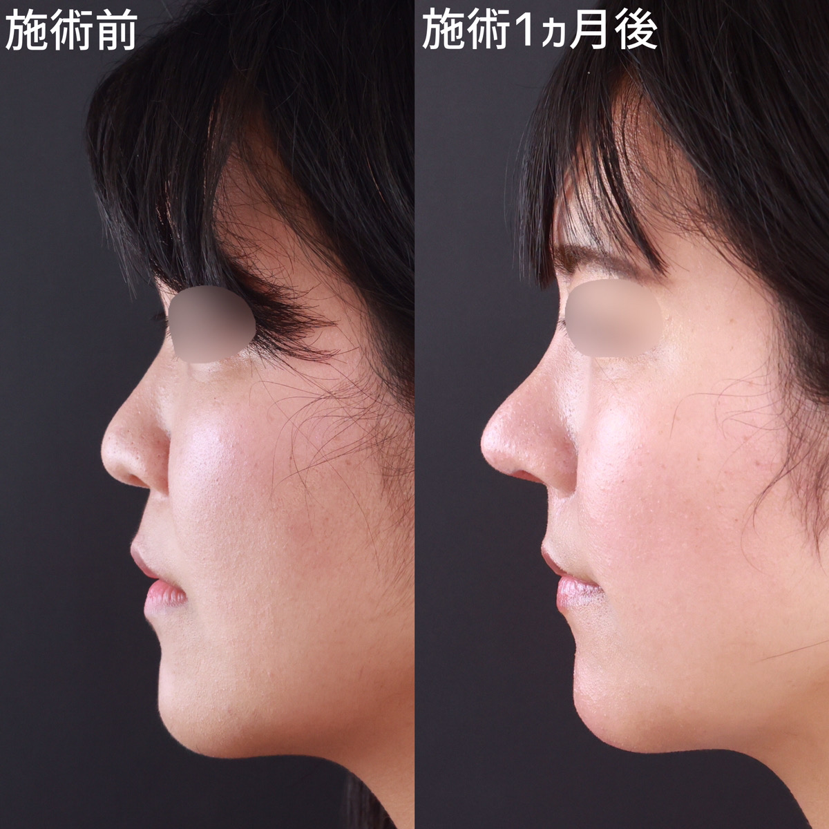 隆鼻術（プロテーゼ・自家組織）/鼻尖形成・鼻尖縮小/鼻中隔延長術の症例写真 施術前後 