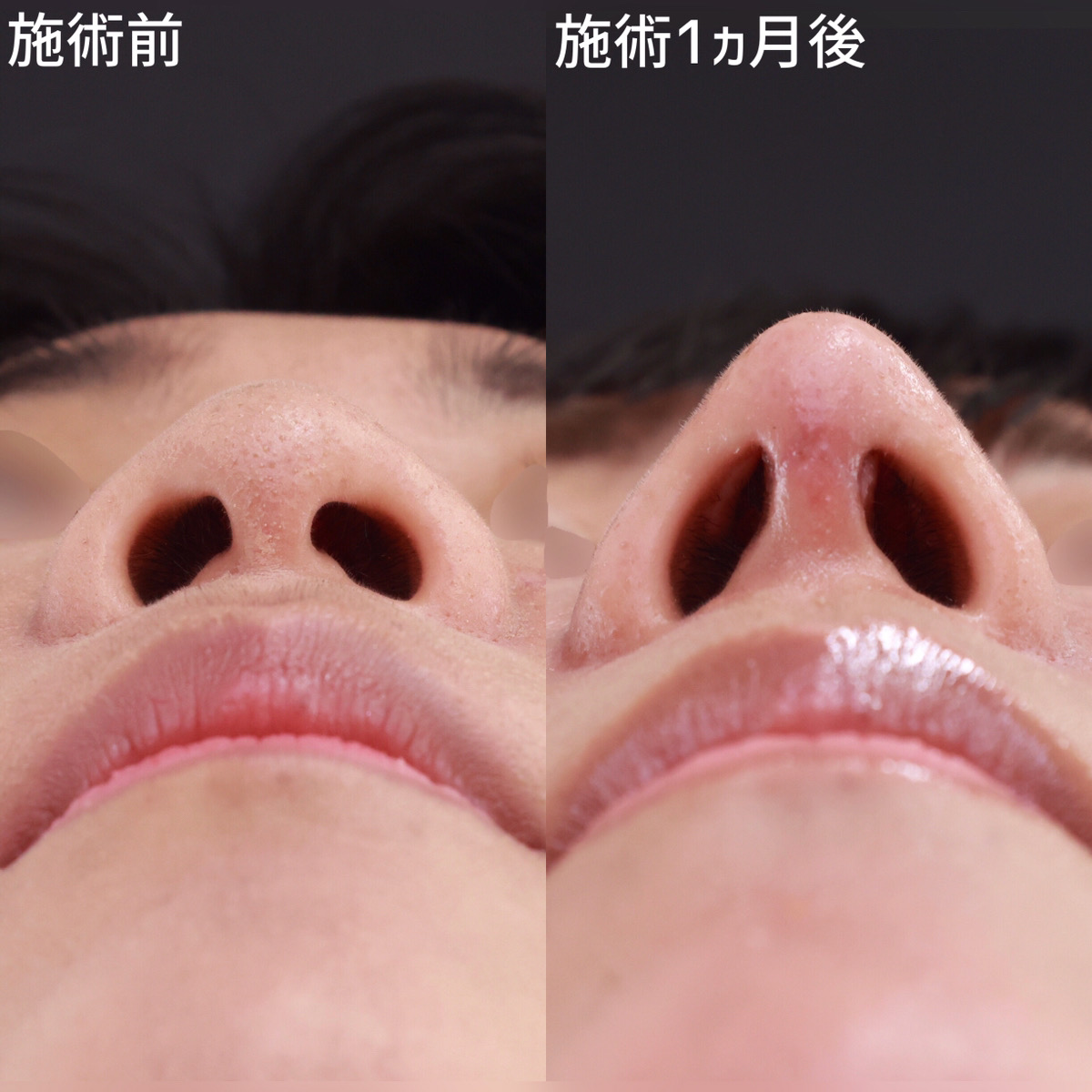 隆鼻術（プロテーゼ・自家組織）/鼻尖形成・鼻尖縮小/鼻中隔延長術の症例写真 施術前後 