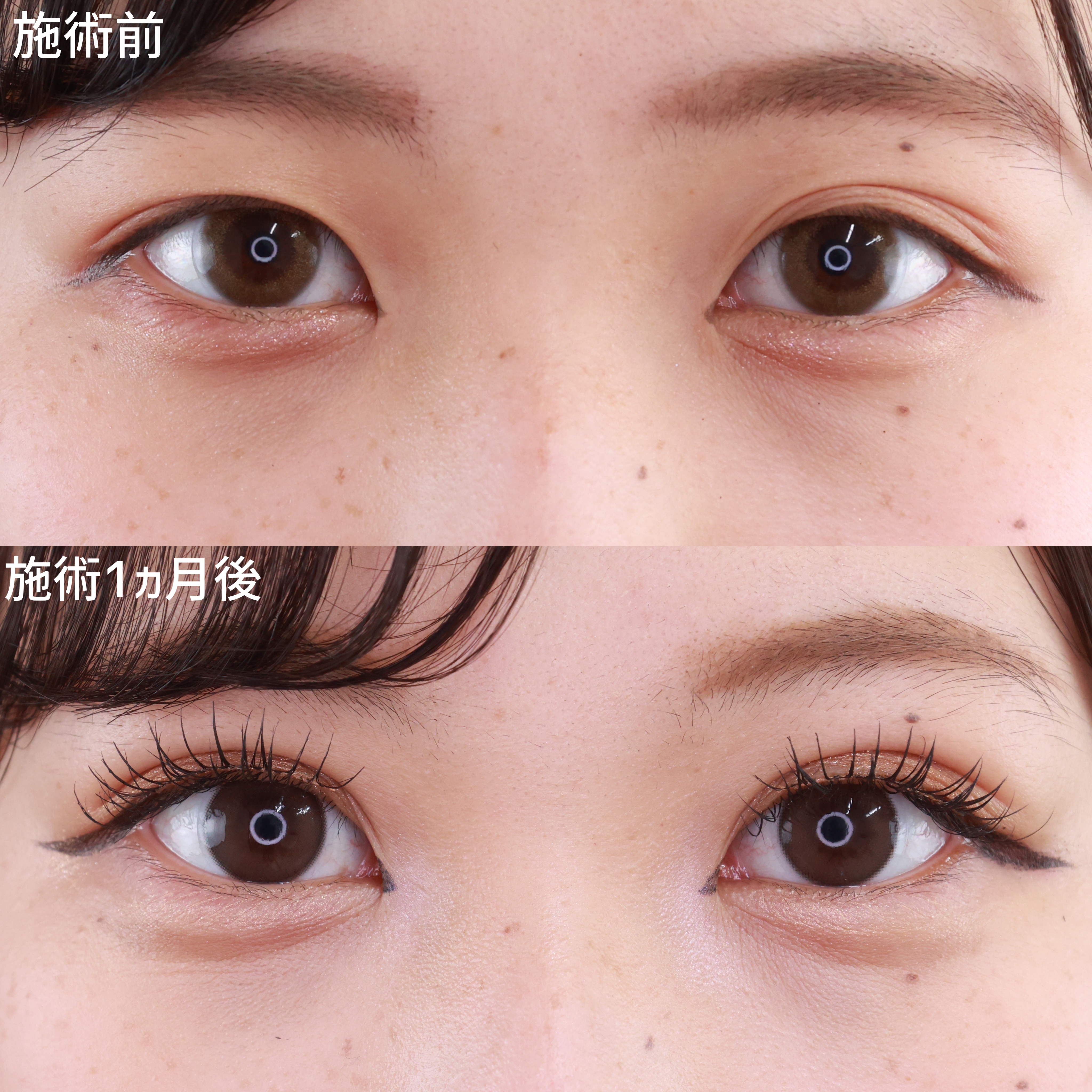 【二重埋没法】左右差のある二重も、整ったぱっちり二重に！