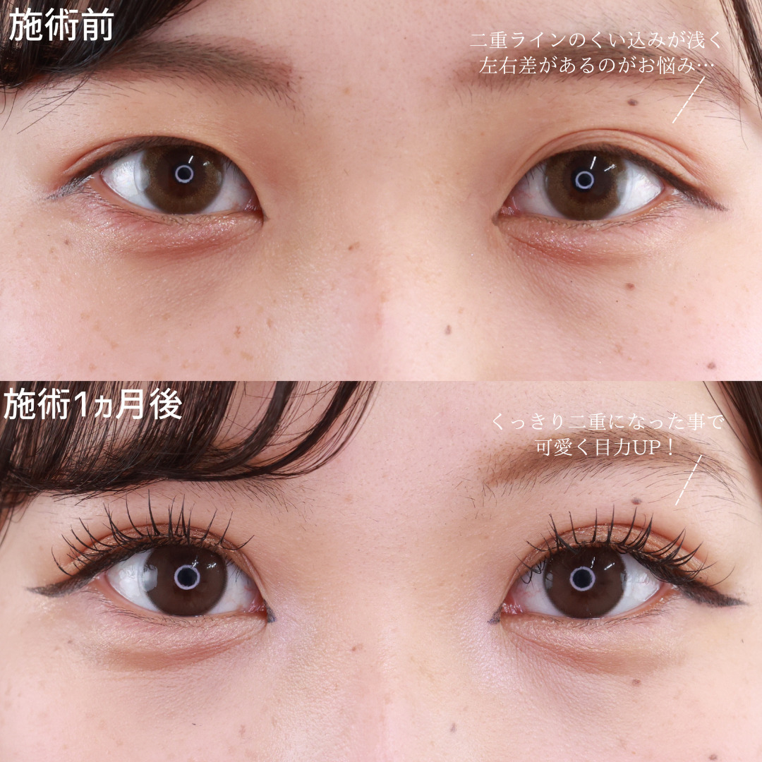 二重埋没法/目元：その他の症例写真 施術前後 
