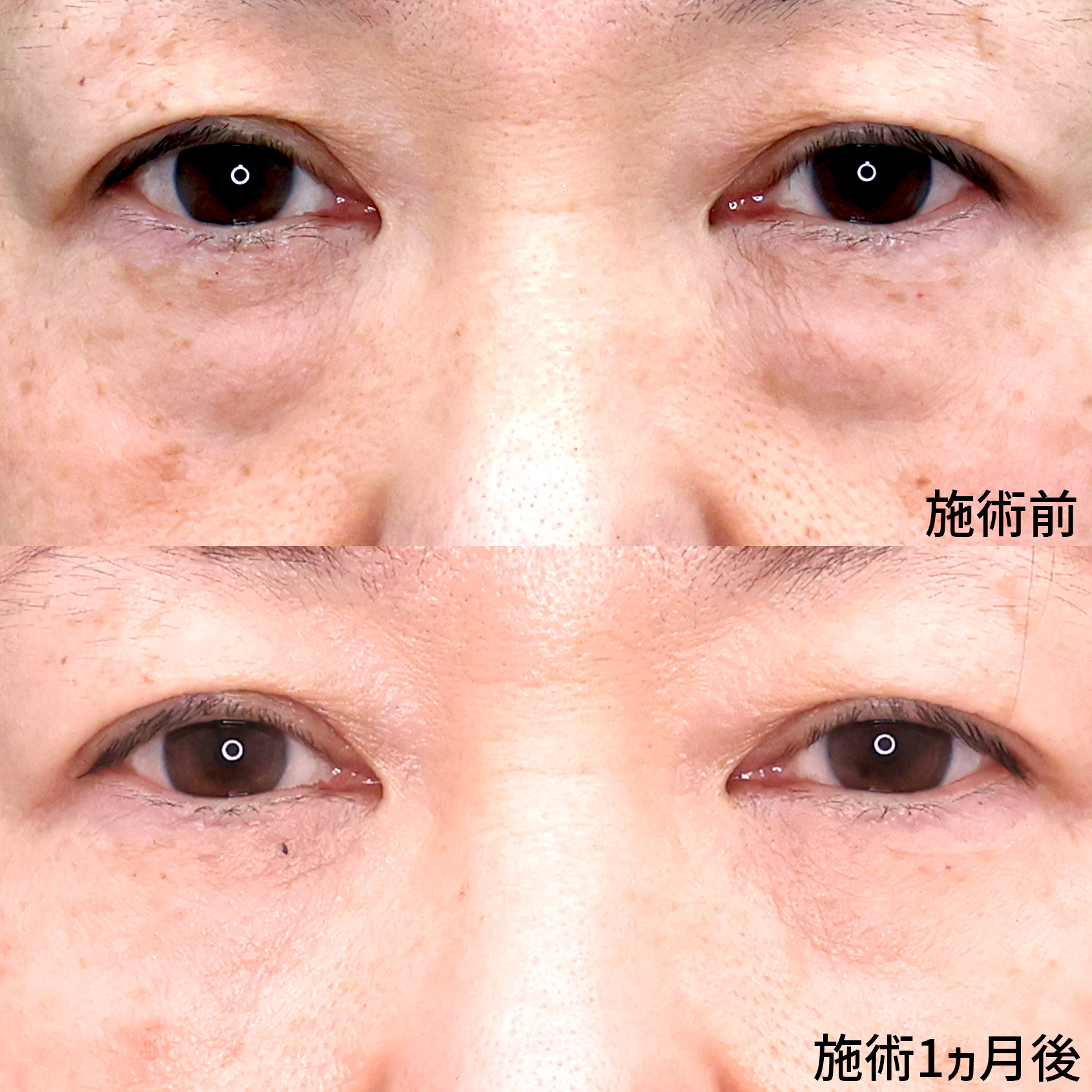 目の下の脂肪除去⁉　スッキリ目元で若々しく！