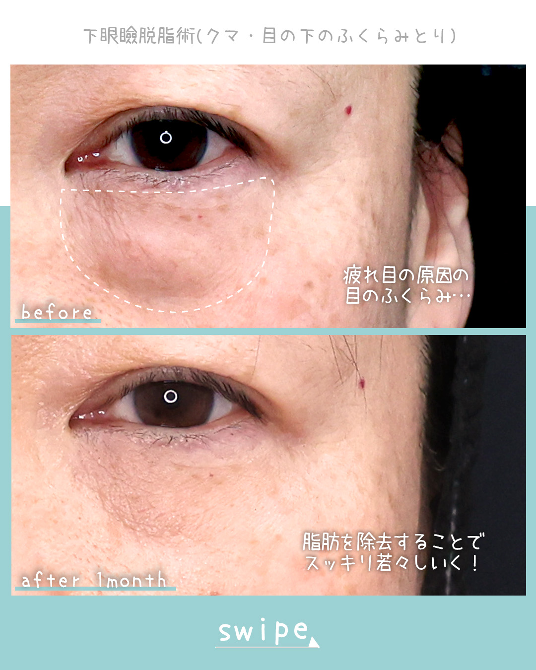 下眼瞼脱脂術（目の下のたるみ取り・目の下の脂肪ふくらみ取り）/目の下のヒアルロン酸注射の症例写真 施術前後 