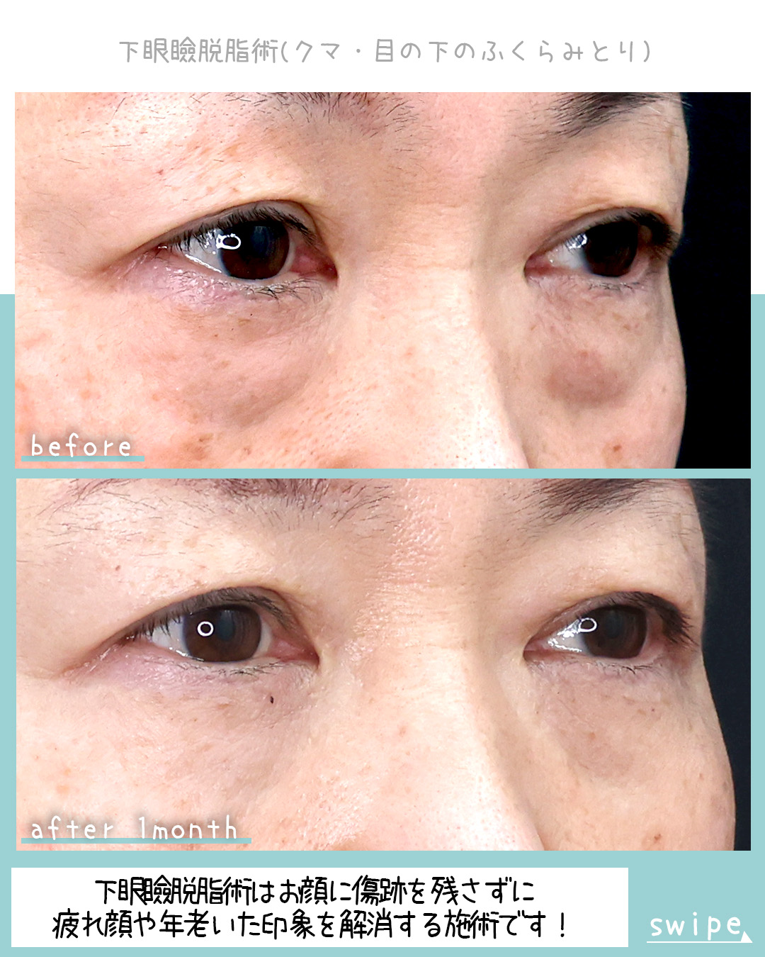 下眼瞼脱脂術（目の下のたるみ取り・目の下の脂肪ふくらみ取り）/目の下のヒアルロン酸注射の症例写真 施術前後 