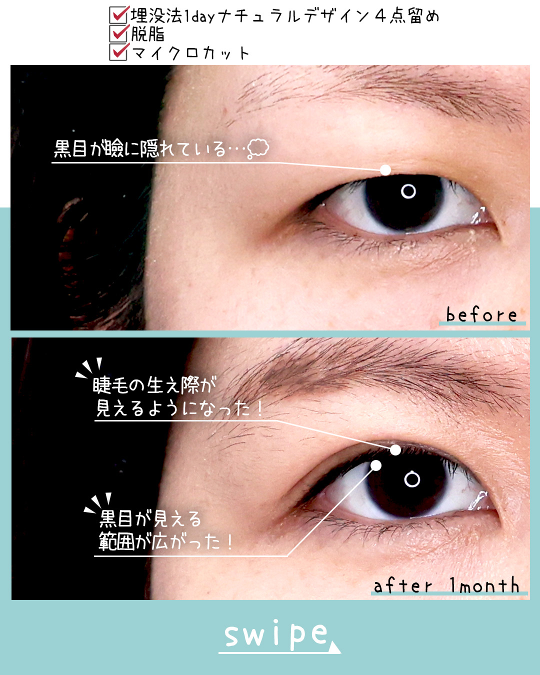 二重埋没法の症例写真 施術前後 