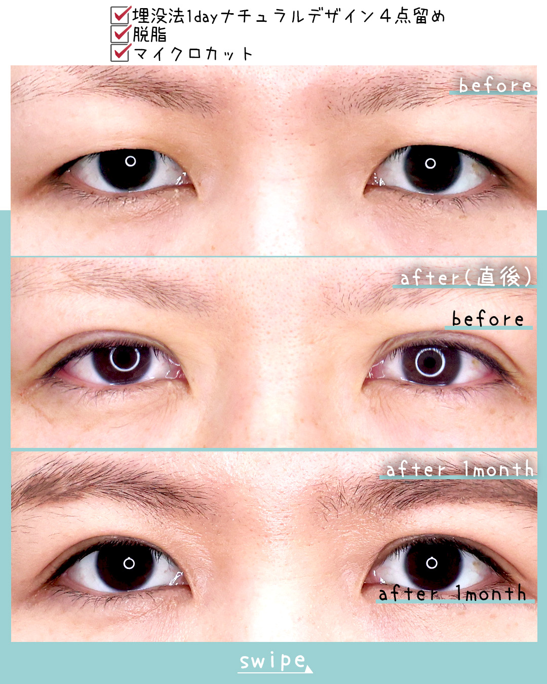 二重埋没法の症例写真 施術前後 