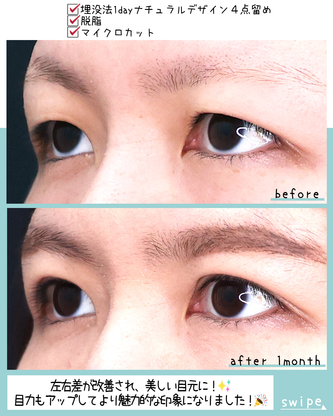 二重埋没法の症例写真 施術前後 