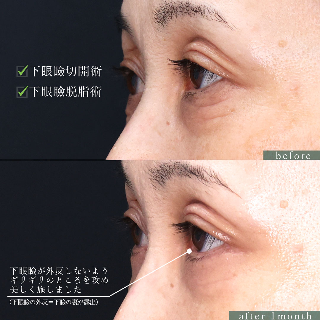 下眼瞼切開術（クマ・たるみとり）/下眼瞼脱脂術（目の下のたるみ取り・目の下の脂肪ふくらみ取り）の症例写真 施術前後 