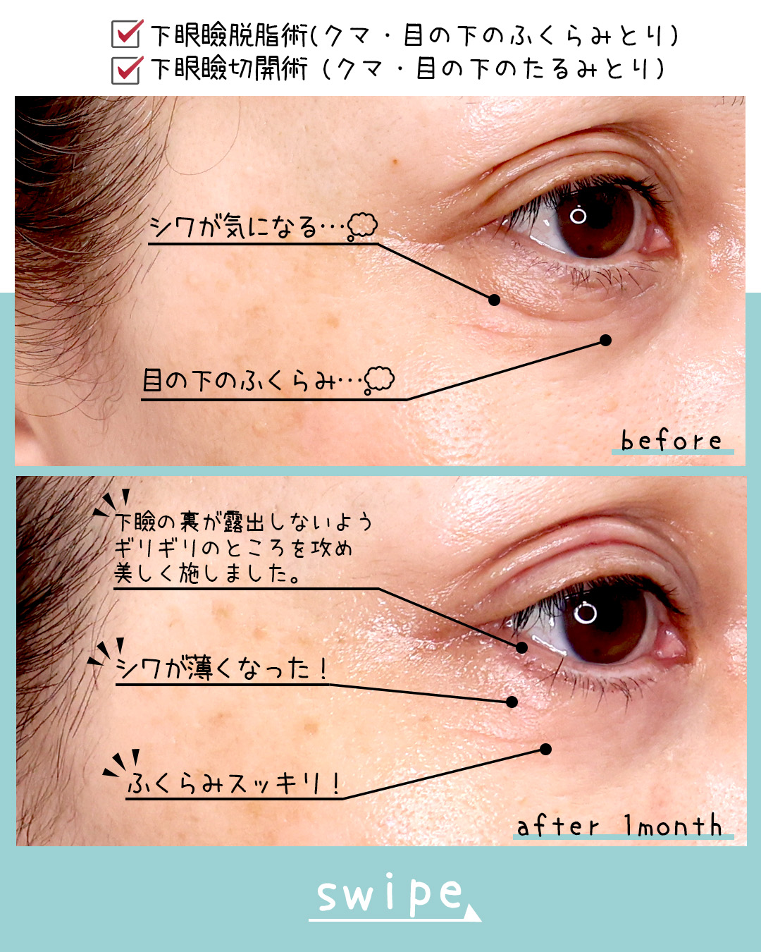 下眼瞼切開術（クマ・たるみとり）/下眼瞼脱脂術（目の下のたるみ取り・目の下の脂肪ふくらみ取り）の症例写真 施術前後 