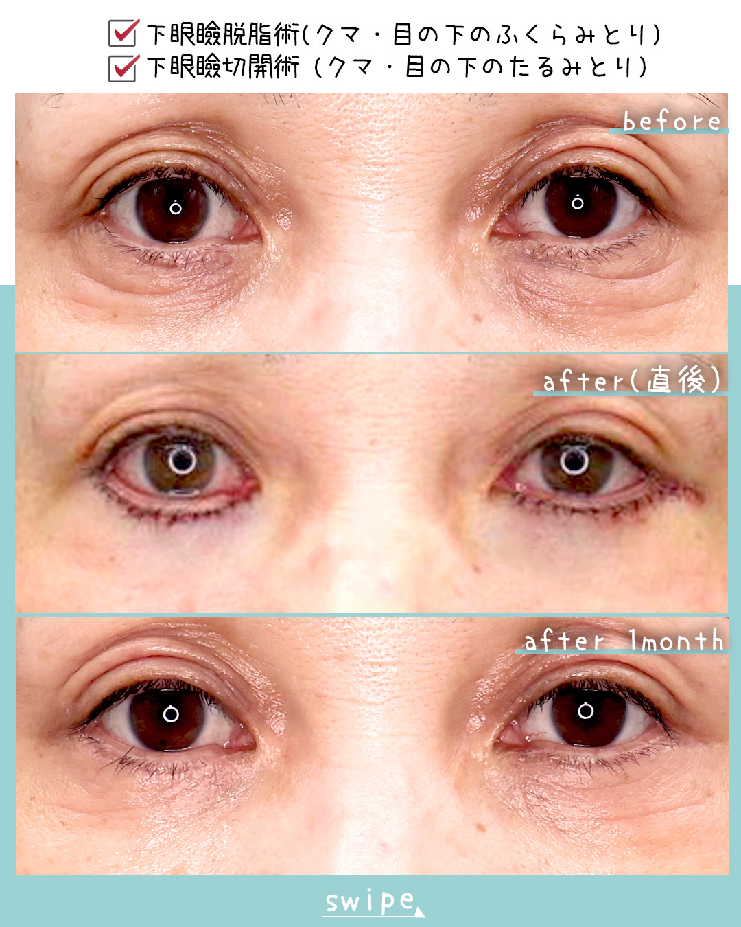 下眼瞼切開術（クマ・たるみとり）/下眼瞼脱脂術（目の下のたるみ取り・目の下の脂肪ふくらみ取り）の症例写真 施術前後 