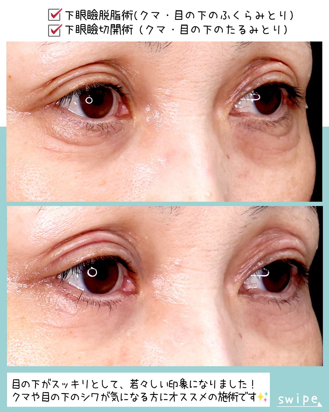 下眼瞼切開術（クマ・たるみとり）/下眼瞼脱脂術（目の下のたるみ取り・目の下の脂肪ふくらみ取り）の症例写真 施術前後 