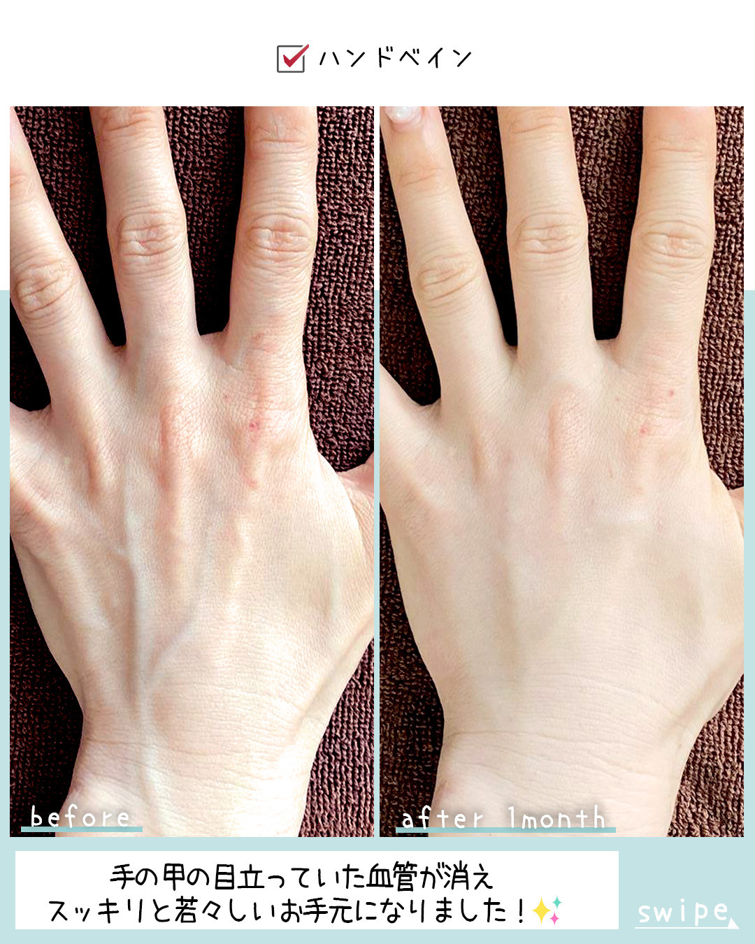 ハンドベイン（手のアンチエイジング・血管治療）の症例写真 施術前後 