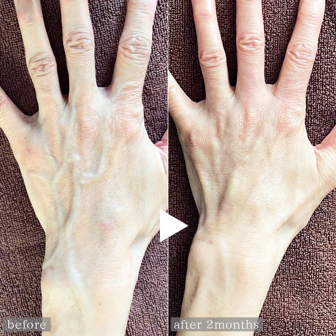 ハンドベイン（手のアンチエイジング・血管治療）の症例写真 施術前後 
