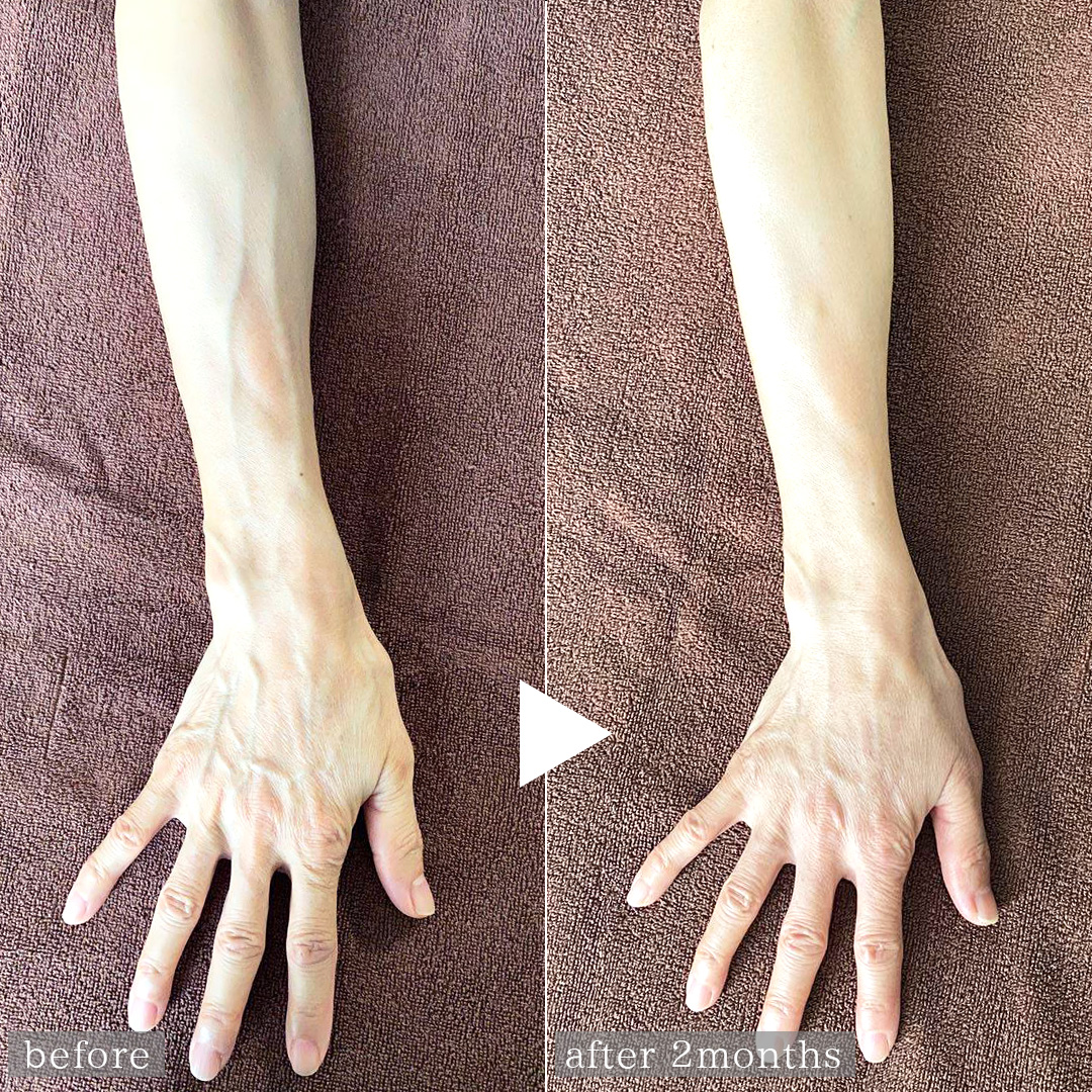 ハンドベイン（手のアンチエイジング・血管治療）の症例写真 施術前後 