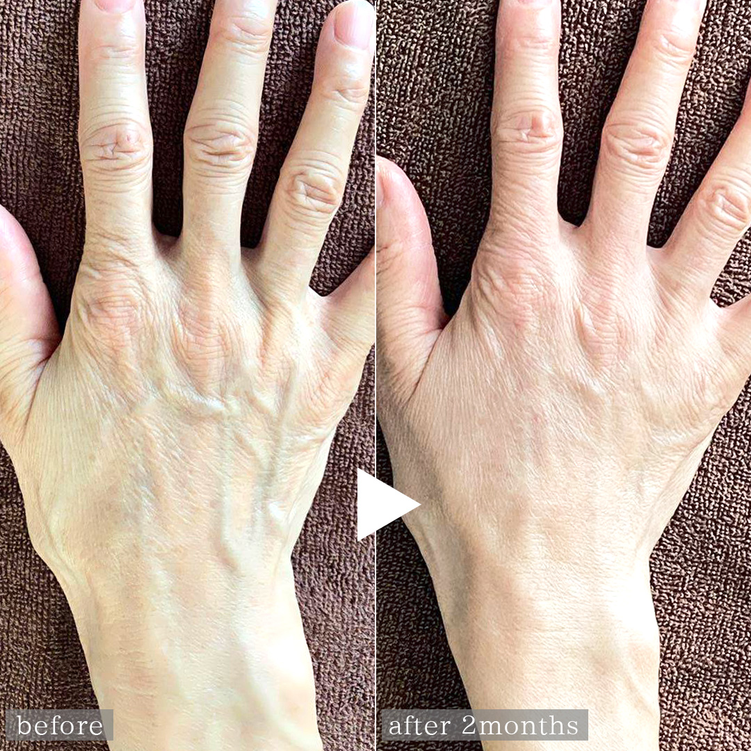 ハンドベイン（手のアンチエイジング・血管治療）の症例写真 施術前後 