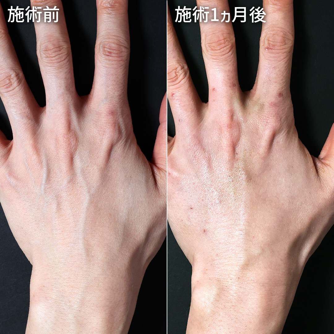 手の血管治療(ハンドベイン)の症例写真 施術前後