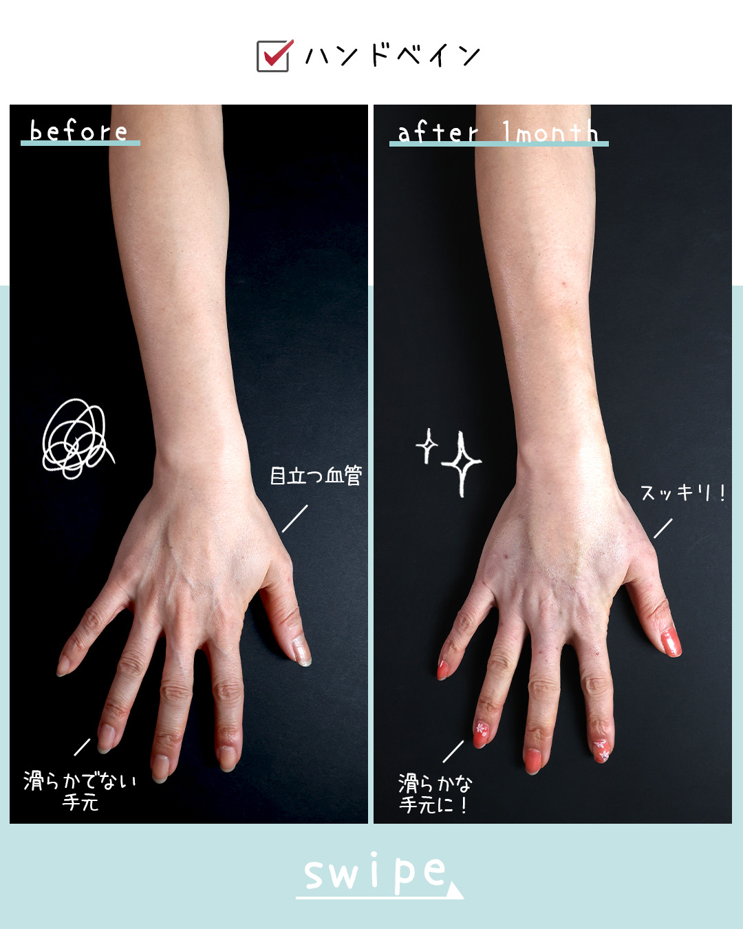 手の血管治療(ハンドベイン)の症例写真 施術前後